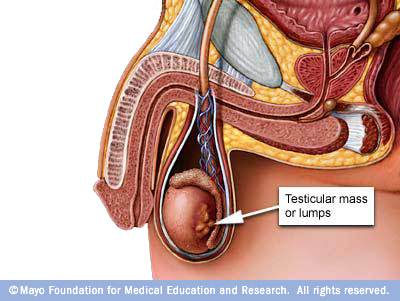 Is testicular cancer visible in photographs?